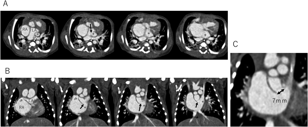 Pediatric Cardiology and Cardiac Surgery 41(3): 133-137 (2025)