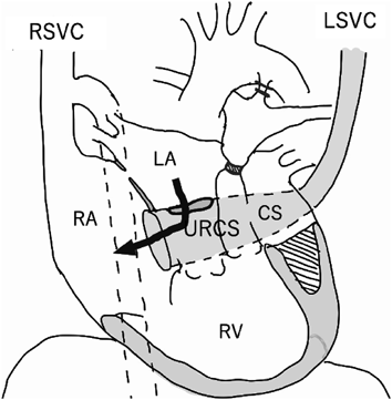 Pediatric Cardiology and Cardiac Surgery 41(3): 133-137 (2025)