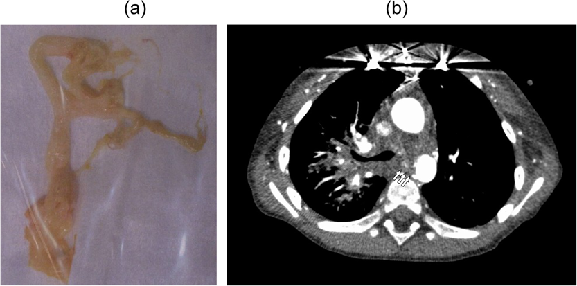 Pediatric Cardiology and Cardiac Surgery 41(3): 145-151 (2025)